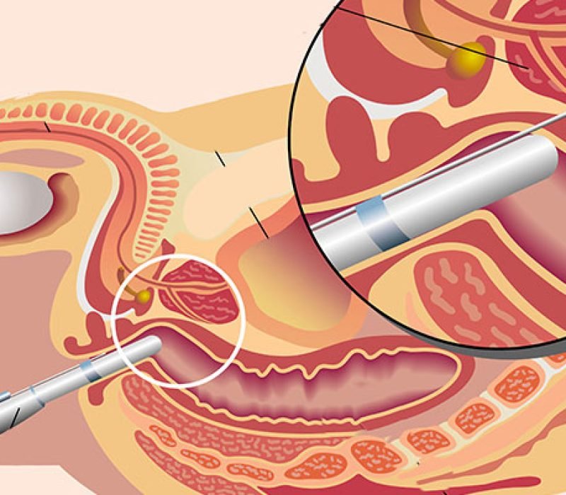 img_biopsie-prostate (1)