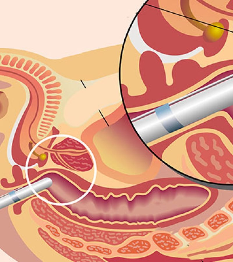 img_biopsie-prostate (1)